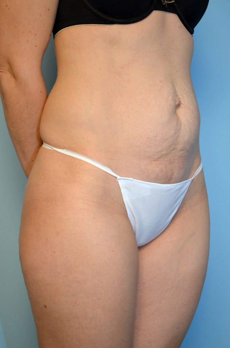 Umbilical Float Tummy Tuck Before & After Gallery - Patient 322179 - Image 3