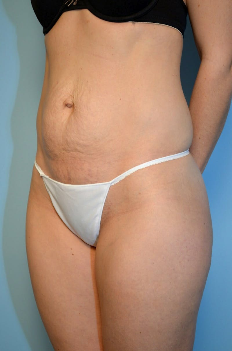 Umbilical Float Tummy Tuck Before & After Gallery - Patient 322179 - Image 7