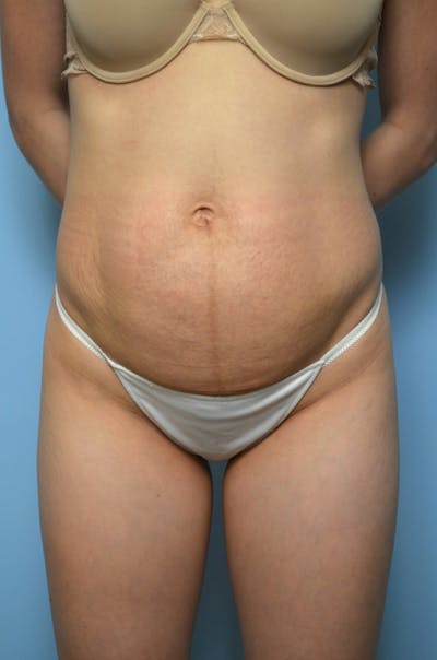 Umbilical Float Tummy Tuck Before & After Gallery - Patient 317102 - Image 1