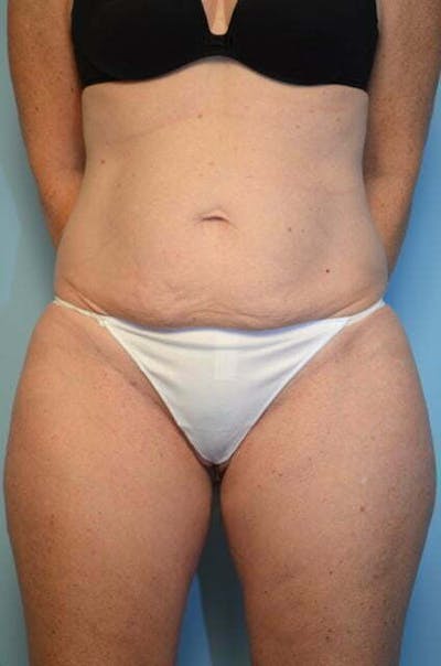 Umbilical Float Tummy Tuck Before & After Gallery - Patient 360196 - Image 1