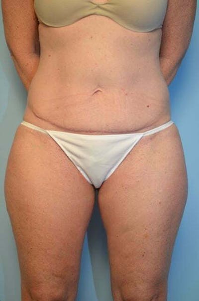 Umbilical Float Tummy Tuck Before & After Gallery - Patient 360196 - Image 2