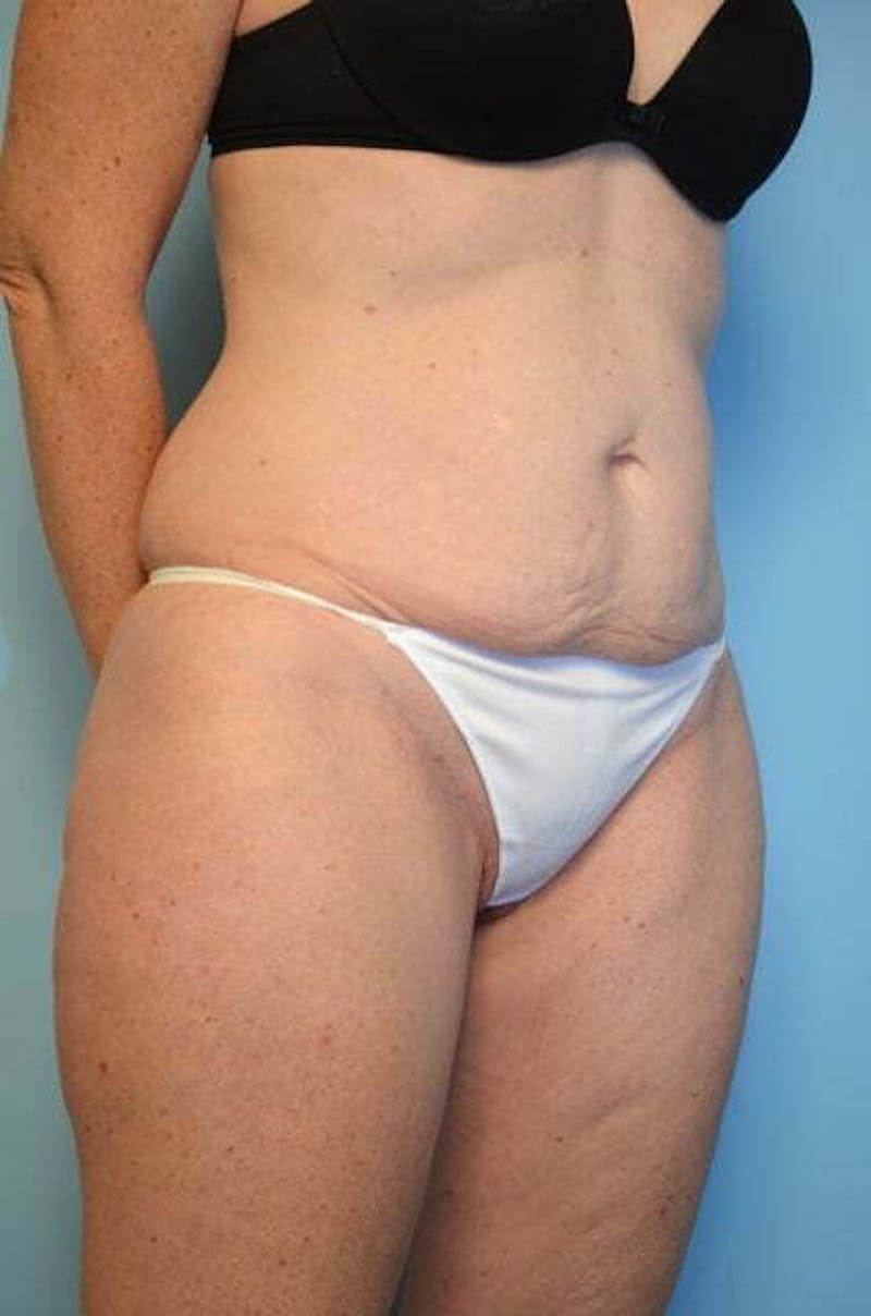 Umbilical Float Tummy Tuck Before & After Gallery - Patient 294702 - Image 3