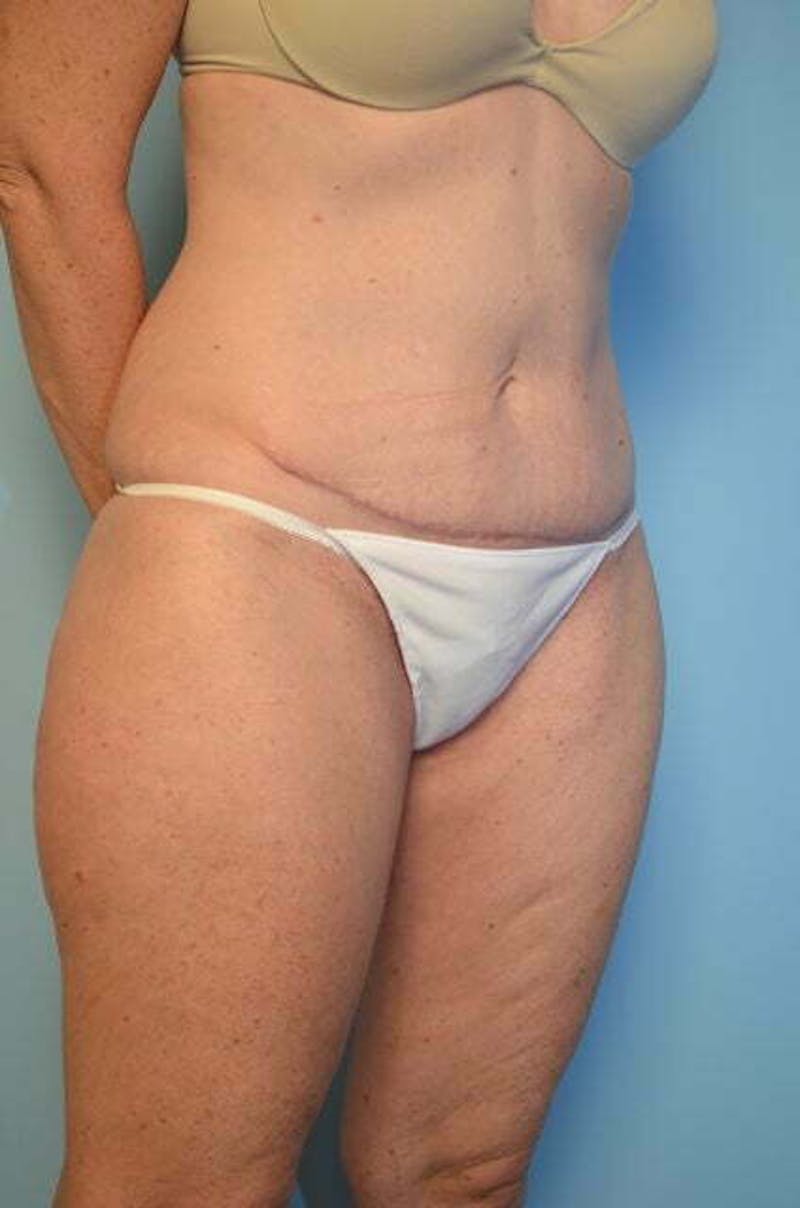 Umbilical Float Tummy Tuck Before & After Gallery - Patient 294702 - Image 4