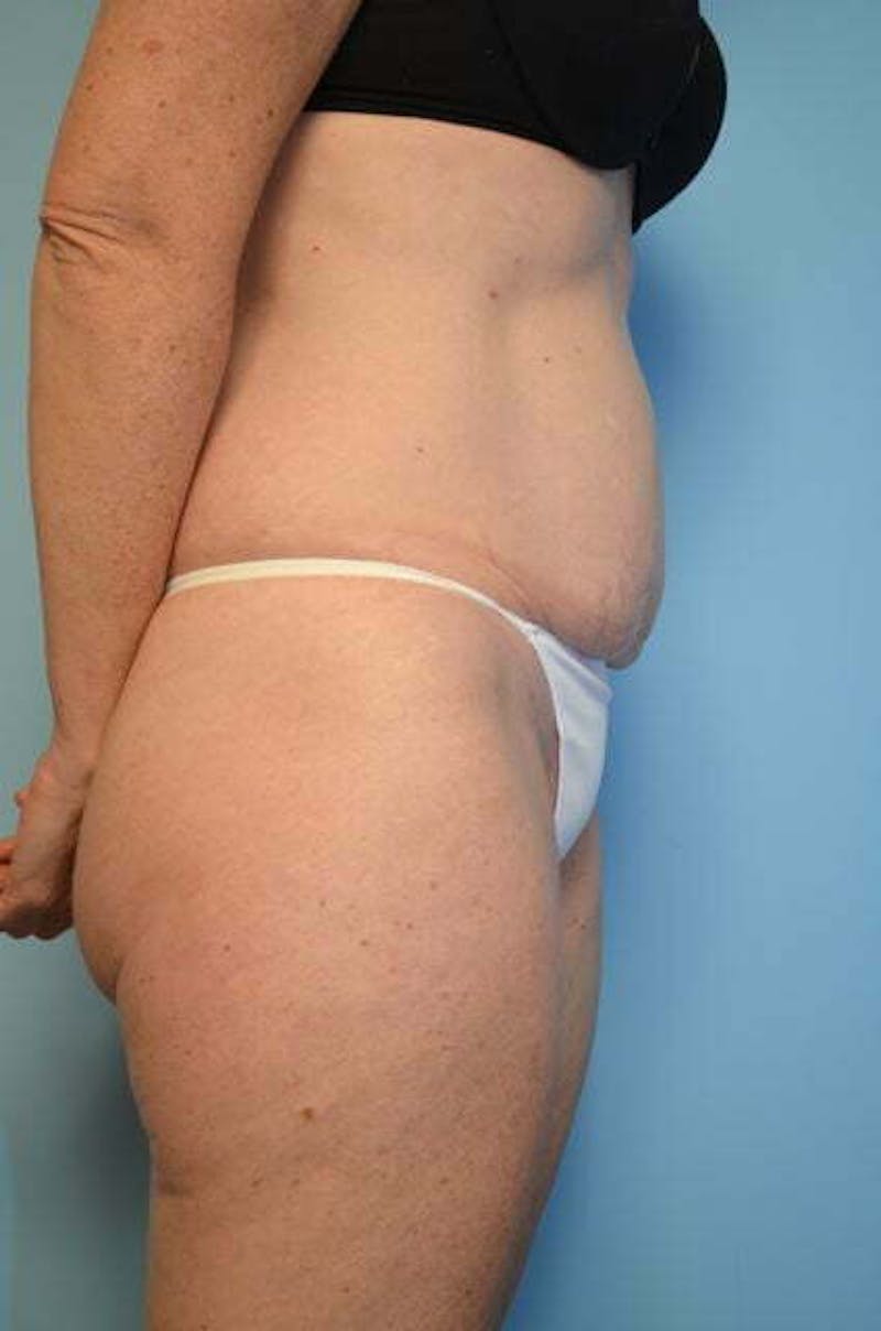 Umbilical Float Tummy Tuck Before & After Gallery - Patient 294702 - Image 5