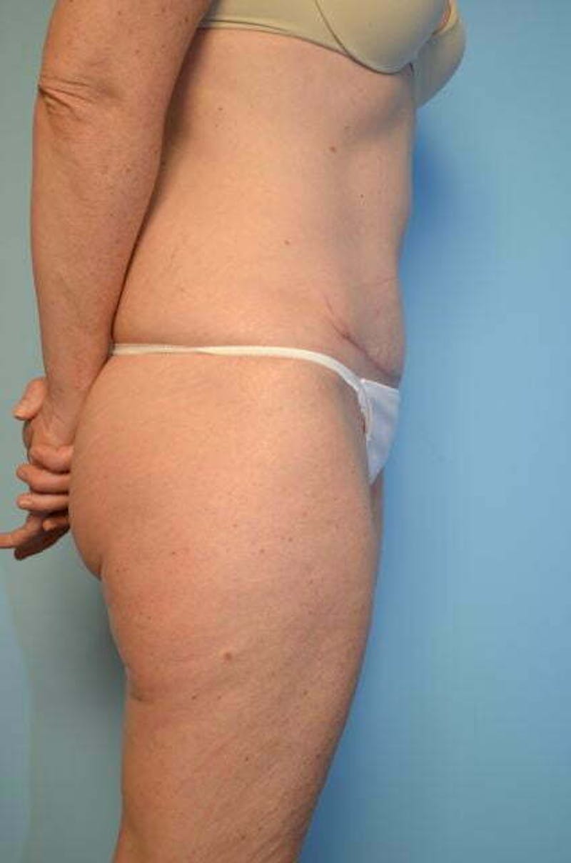 Umbilical Float Tummy Tuck Before & After Gallery - Patient 294702 - Image 6