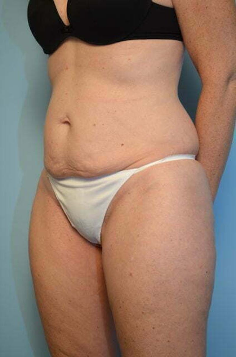 Umbilical Float Tummy Tuck Before & After Gallery - Patient 294702 - Image 7