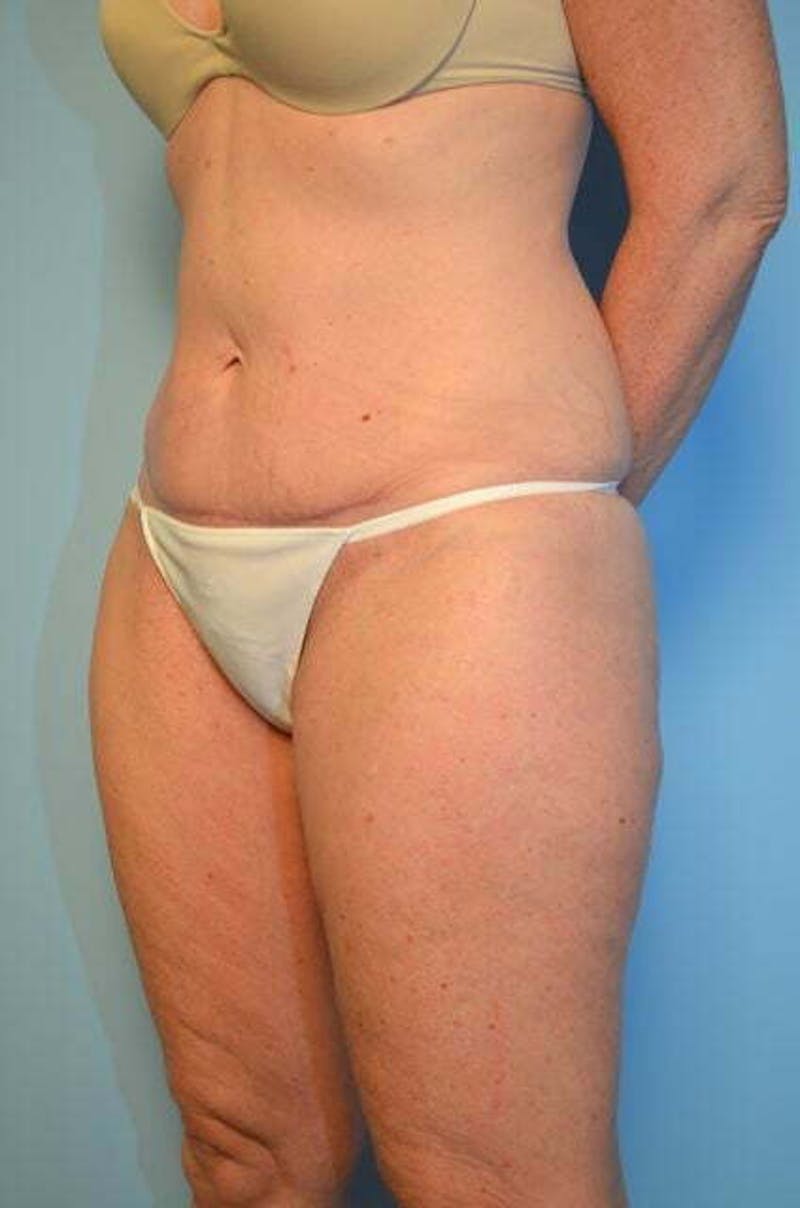 Umbilical Float Tummy Tuck Before & After Gallery - Patient 294702 - Image 8