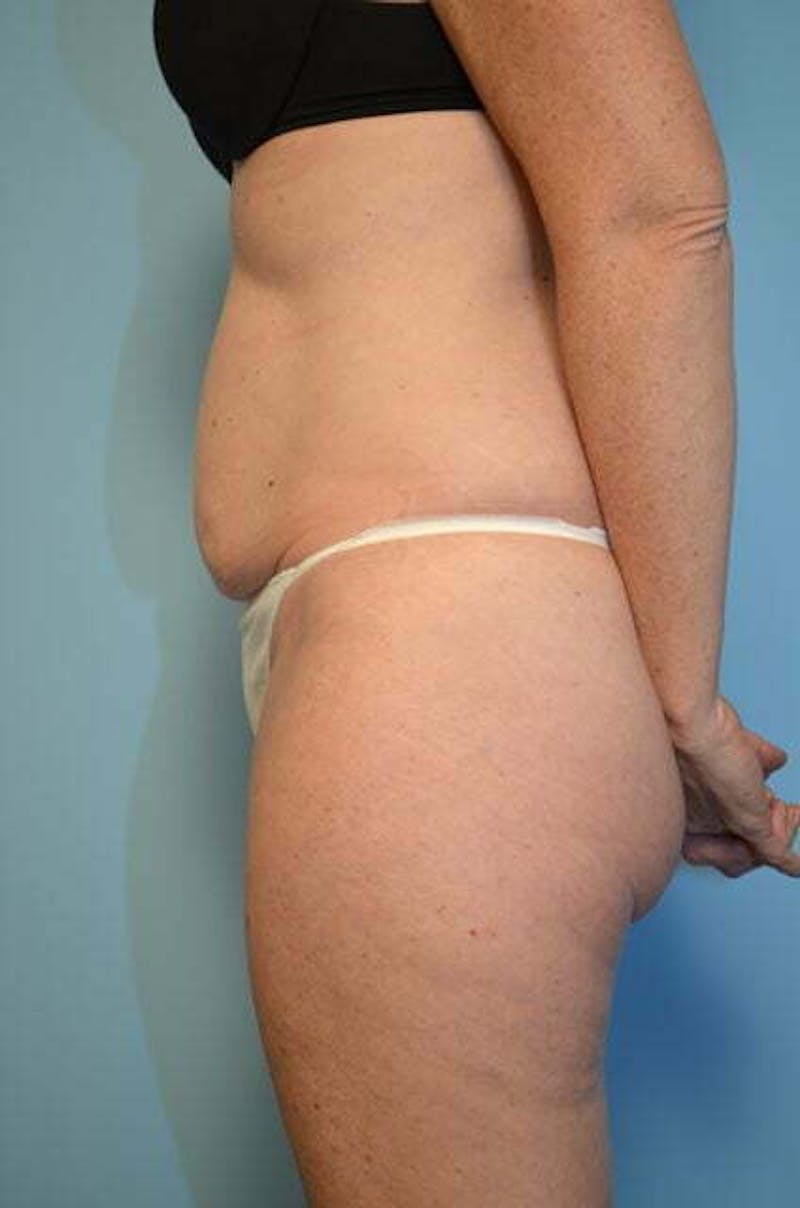 Umbilical Float Tummy Tuck Before & After Gallery - Patient 294702 - Image 9