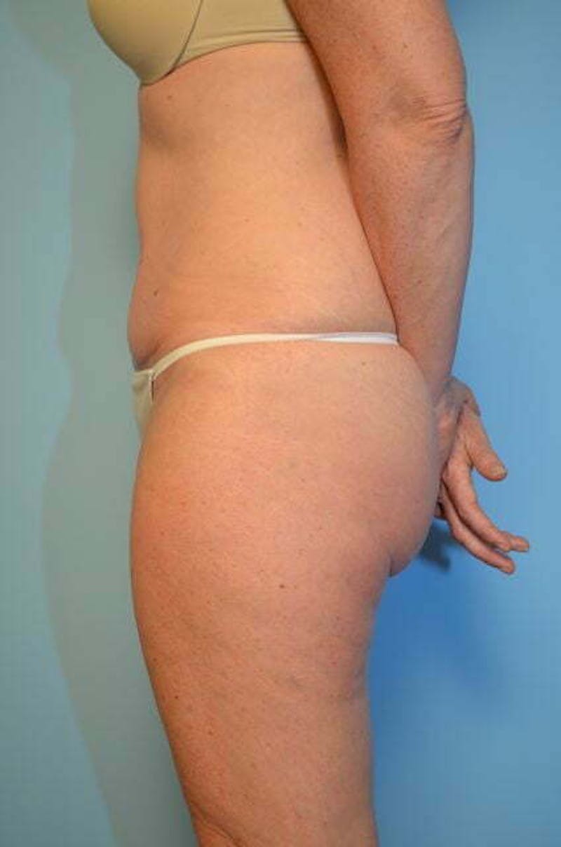 Umbilical Float Tummy Tuck Before & After Gallery - Patient 294702 - Image 10