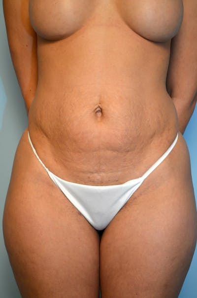 Umbilical Float Tummy Tuck Before & After Gallery - Patient 302942 - Image 1