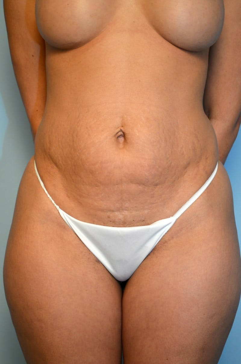 Umbilical Float Tummy Tuck Before & After Gallery - Patient 123131 - Image 1