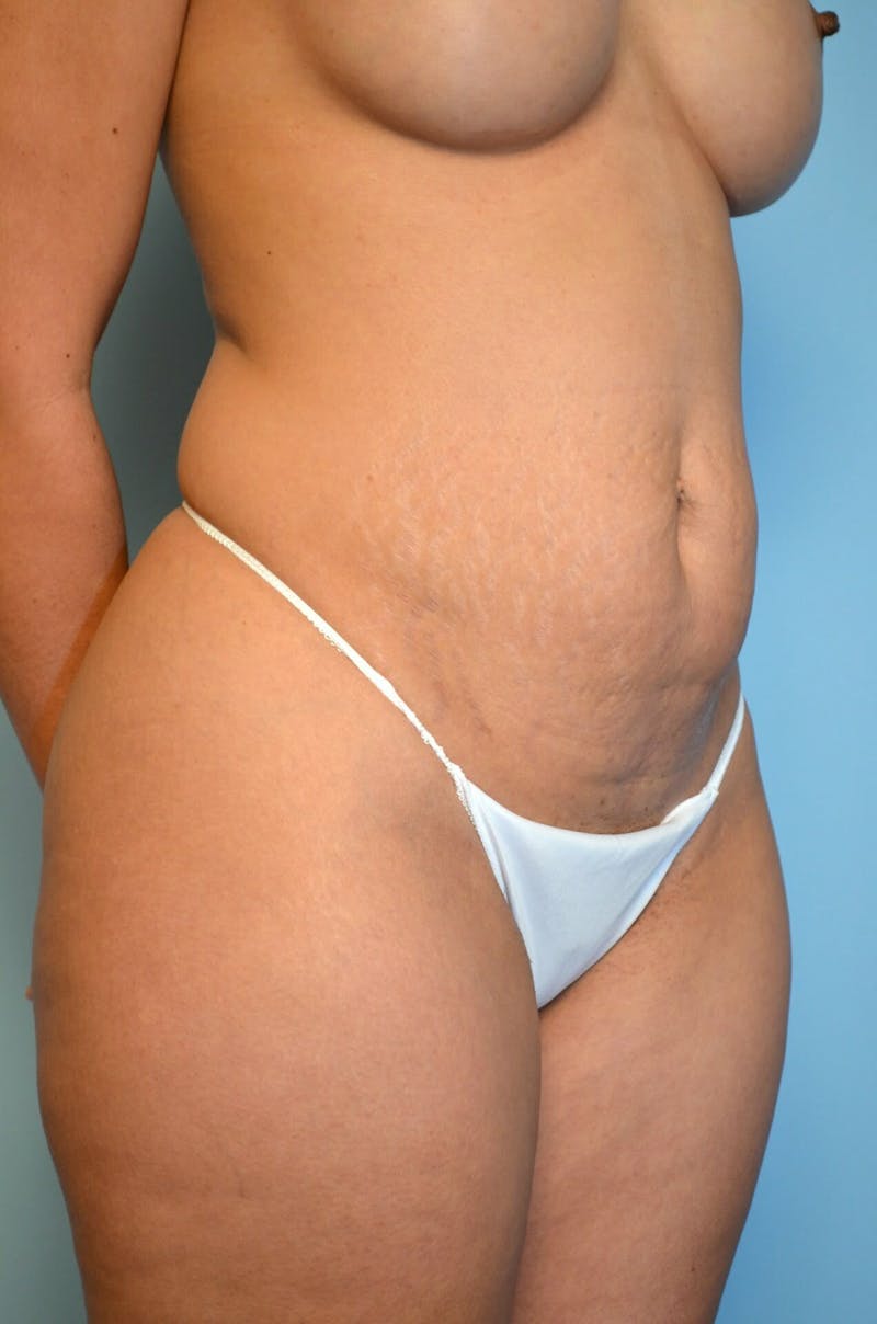 Umbilical Float Tummy Tuck Before & After Gallery - Patient 123131 - Image 3