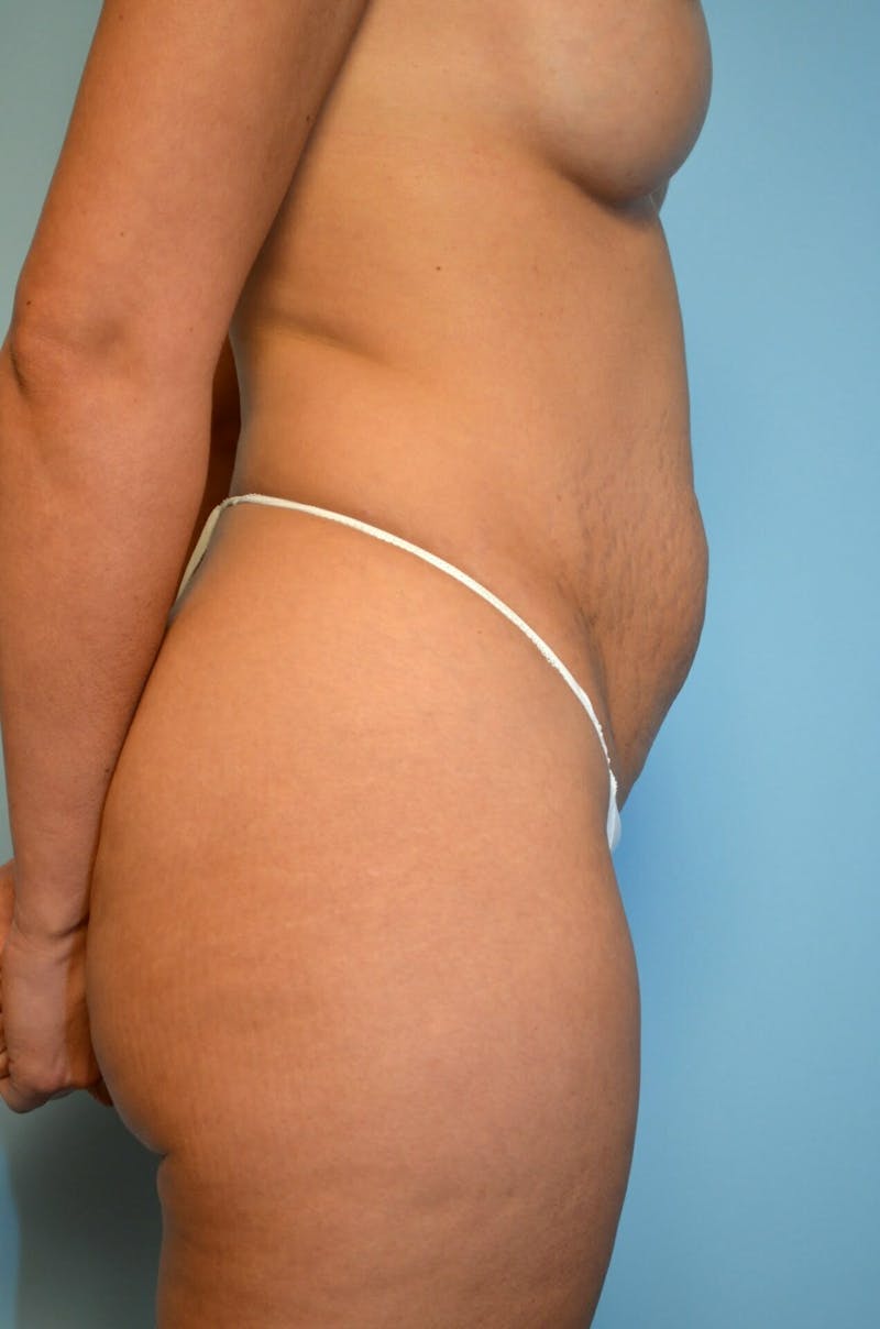 Umbilical Float Tummy Tuck Before & After Gallery - Patient 123131 - Image 5