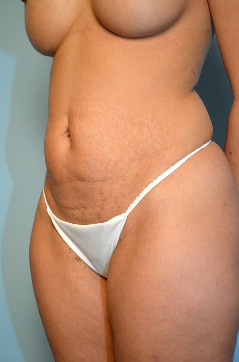 Umbilical Float Tummy Tuck Before & After Gallery - Patient 123131 - Image 7