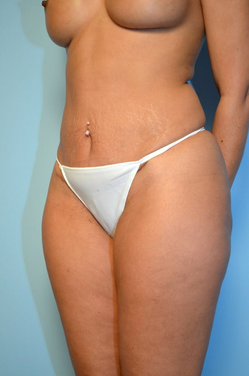 Umbilical Float Tummy Tuck Before & After Gallery - Patient 123131 - Image 8
