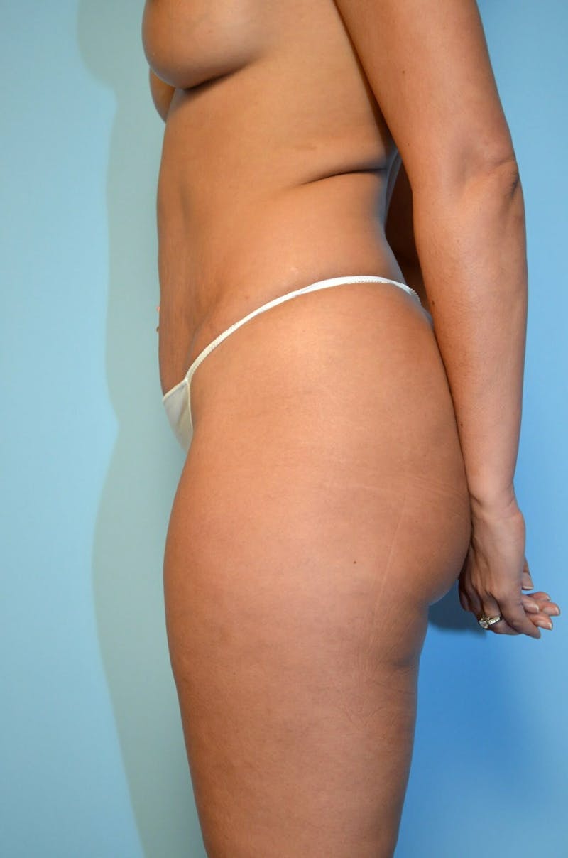 Umbilical Float Tummy Tuck Before & After Gallery - Patient 123131 - Image 10