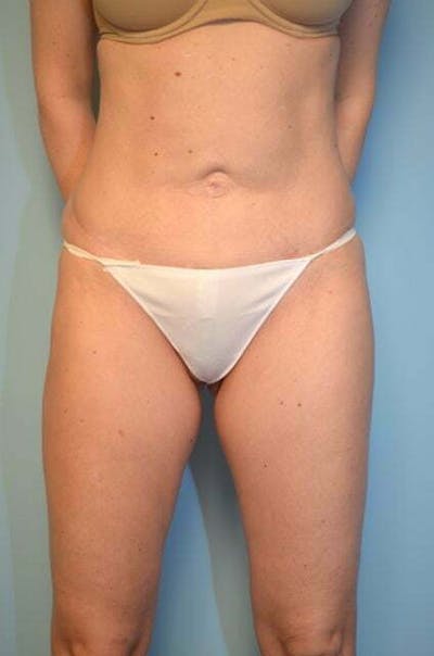 Umbilical Float Tummy Tuck Before & After Gallery - Patient 126671 - Image 1