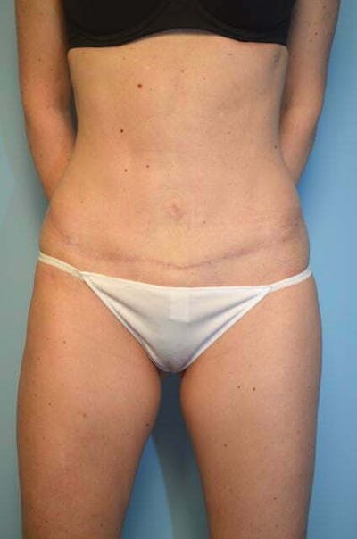 Umbilical Float Tummy Tuck Before & After Gallery - Patient 126671 - Image 2