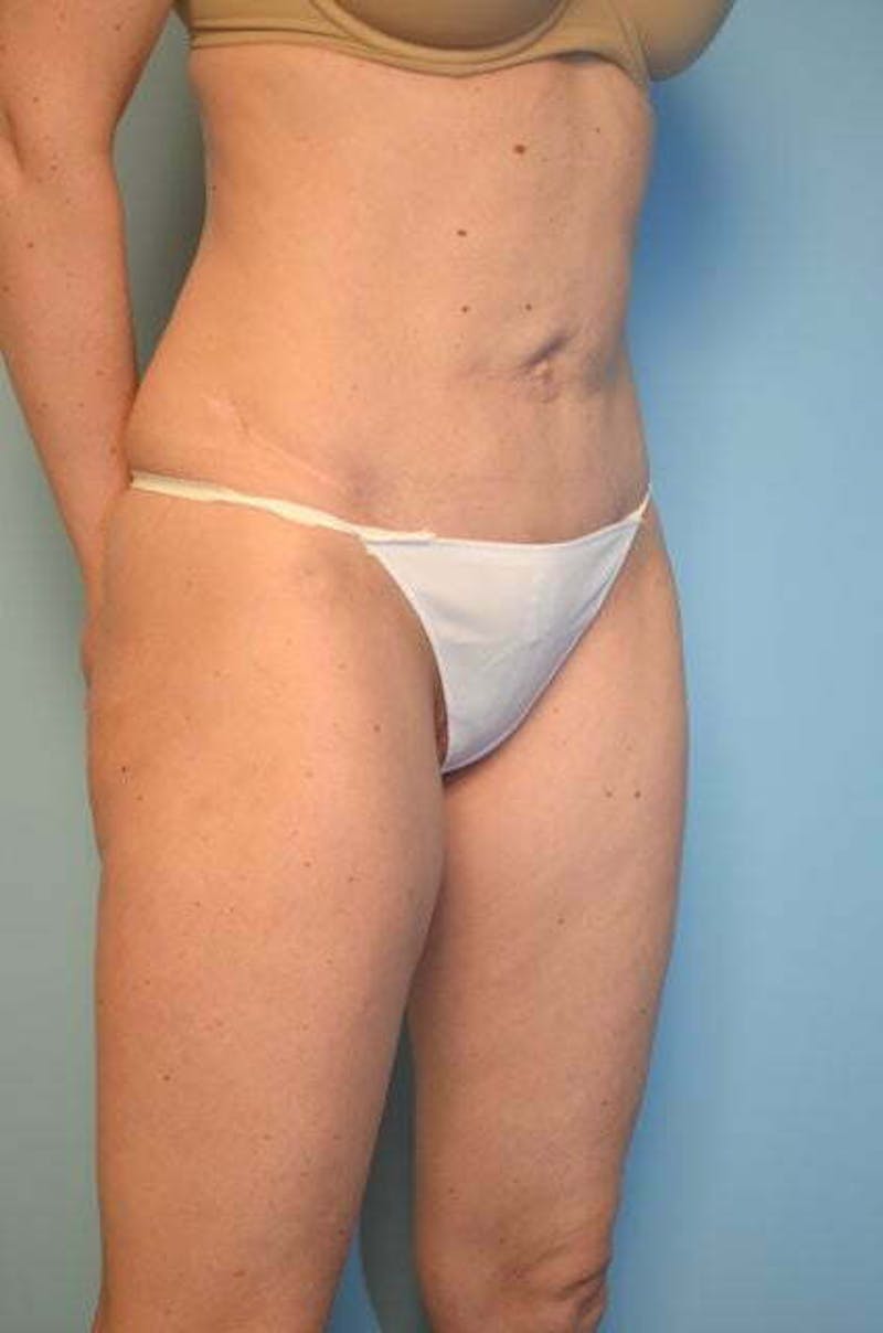 Umbilical Float Tummy Tuck Before & After Gallery - Patient 575219 - Image 3