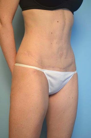 Umbilical Float Tummy Tuck Before & After Gallery - Patient 575219 - Image 4