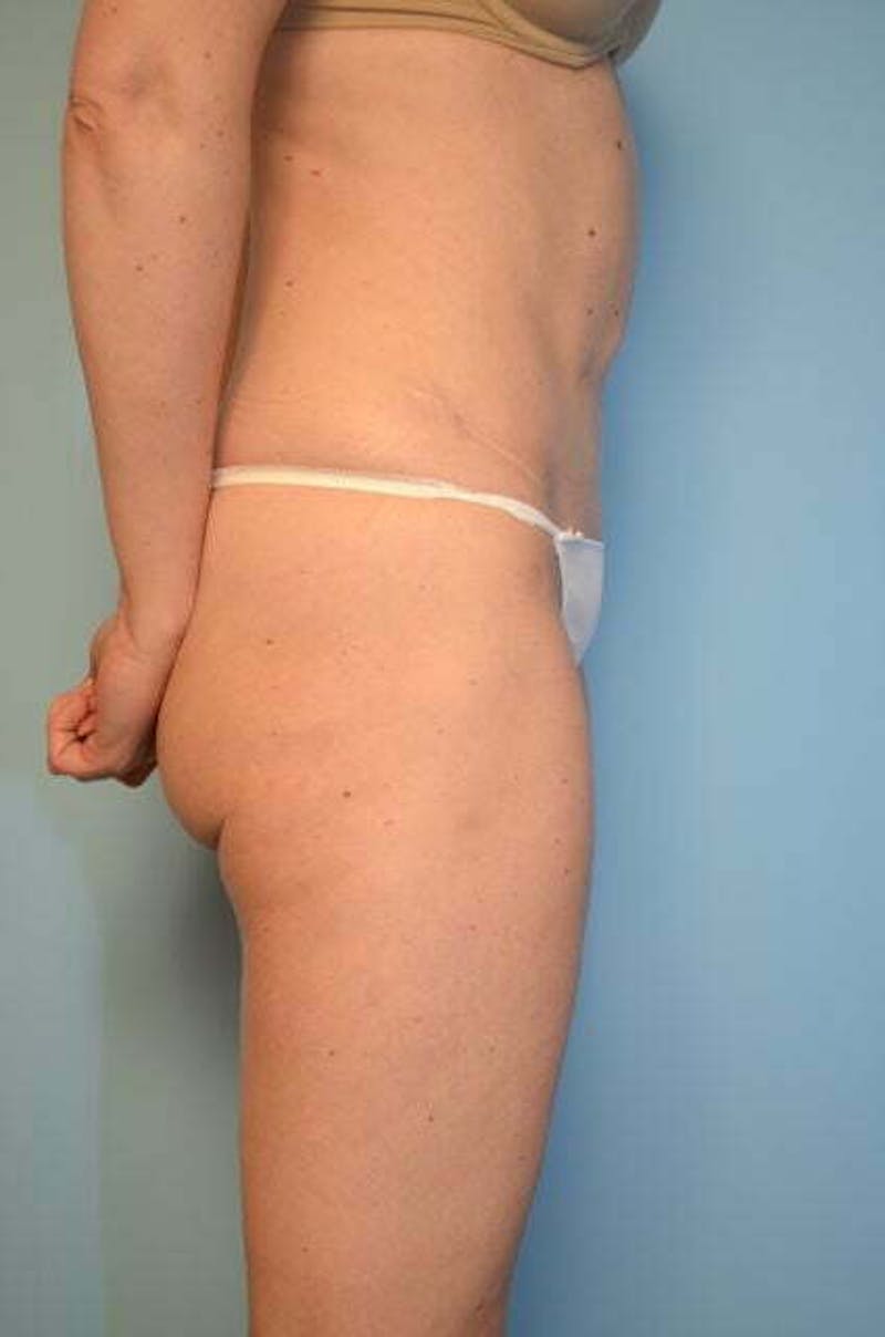 Umbilical Float Tummy Tuck Before & After Gallery - Patient 575219 - Image 5