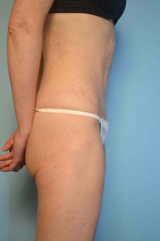 Umbilical Float Tummy Tuck Before & After Gallery - Patient 575219 - Image 6