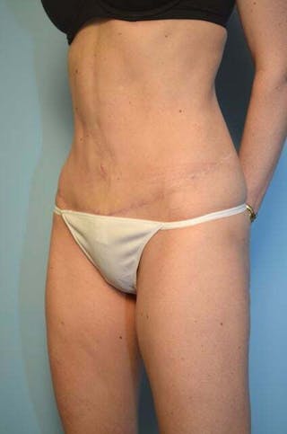 Umbilical Float Tummy Tuck Before & After Gallery - Patient 575219 - Image 8