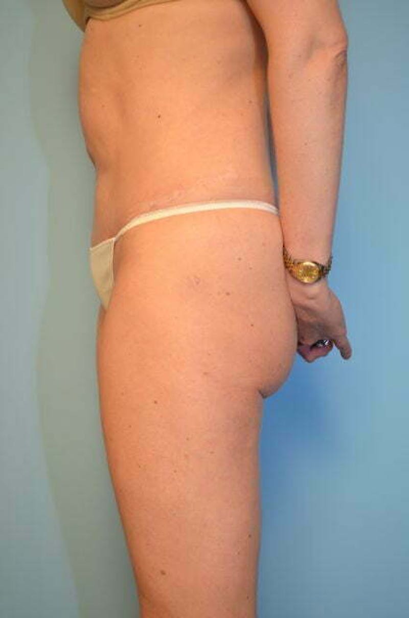 Umbilical Float Tummy Tuck Before & After Gallery - Patient 575219 - Image 9