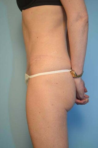 Umbilical Float Tummy Tuck Before & After Gallery - Patient 575219 - Image 10
