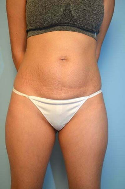 Umbilical Float Tummy Tuck Before & After Gallery - Patient 339976 - Image 1