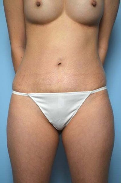 Umbilical Float Tummy Tuck Before & After Gallery - Patient 339976 - Image 2