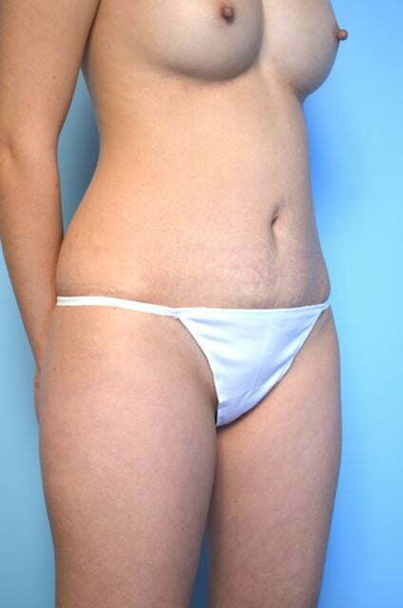 Umbilical Float Tummy Tuck Before & After Gallery - Patient 149374 - Image 4
