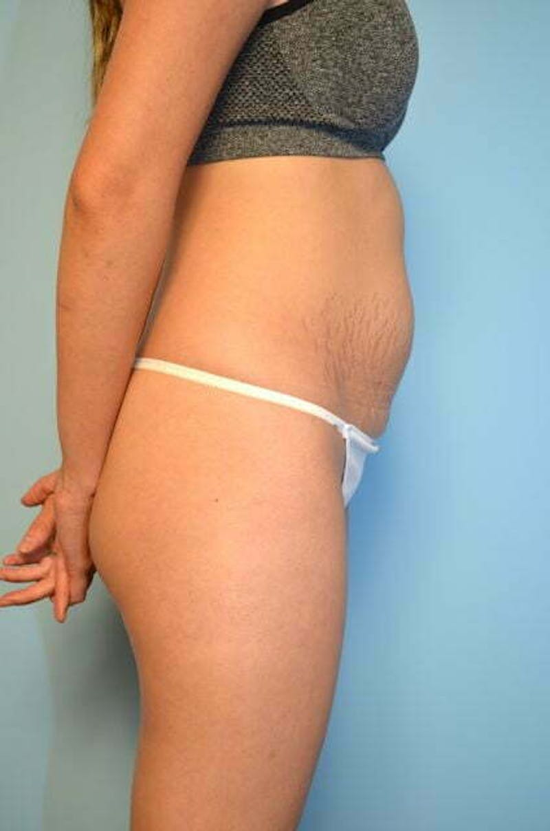 Umbilical Float Tummy Tuck Before & After Gallery - Patient 149374 - Image 5