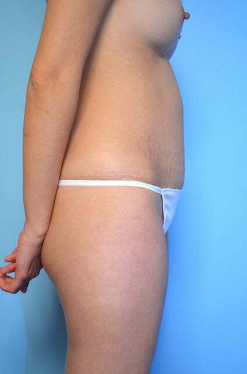 Umbilical Float Tummy Tuck Before & After Gallery - Patient 149374 - Image 6
