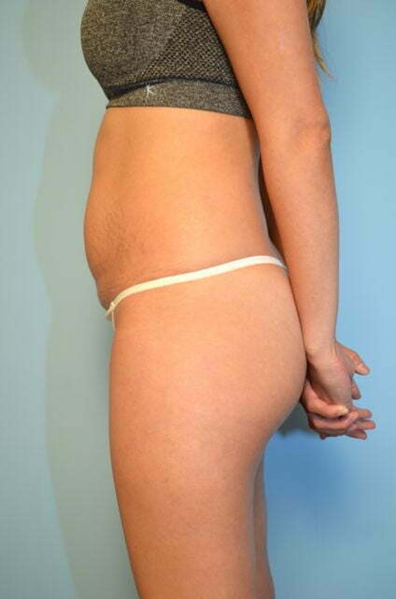Umbilical Float Tummy Tuck Before & After Gallery - Patient 149374 - Image 9