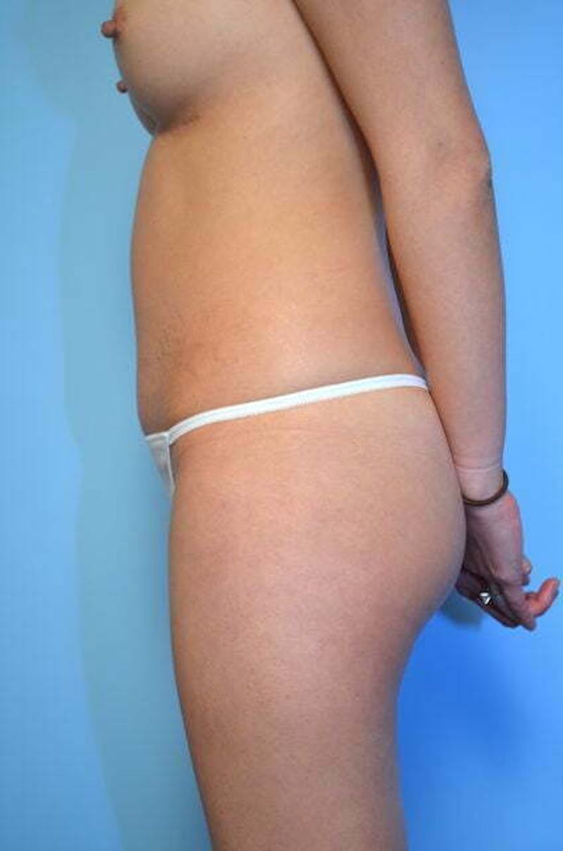Umbilical Float Tummy Tuck Before & After Gallery - Patient 149374 - Image 10