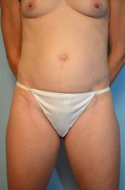 Umbilical Float Tummy Tuck Before & After Gallery - Patient 424954 - Image 1