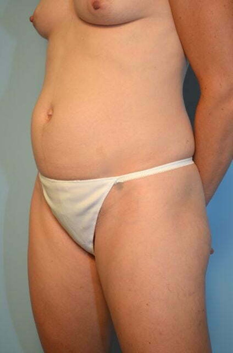 Umbilical Float Tummy Tuck Before & After Gallery - Patient 424954 - Image 7