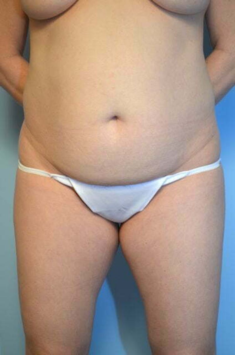 Umbilical Float Tummy Tuck Before & After Gallery - Patient 179410 - Image 1