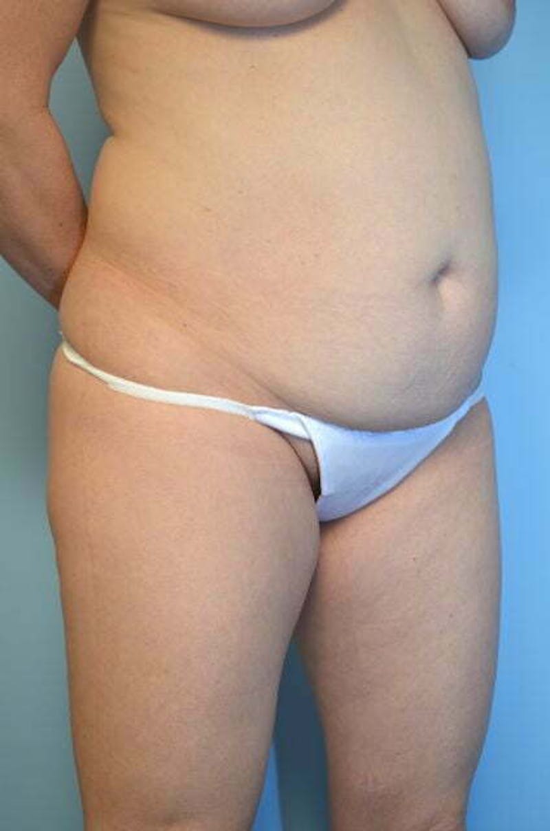 Umbilical Float Tummy Tuck Before & After Gallery - Patient 179410 - Image 3