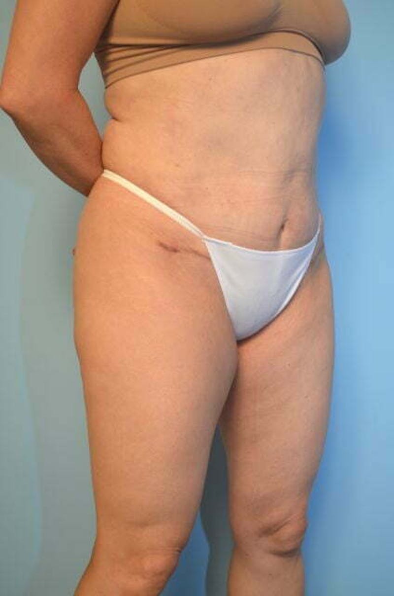 Umbilical Float Tummy Tuck Before & After Gallery - Patient 179410 - Image 4