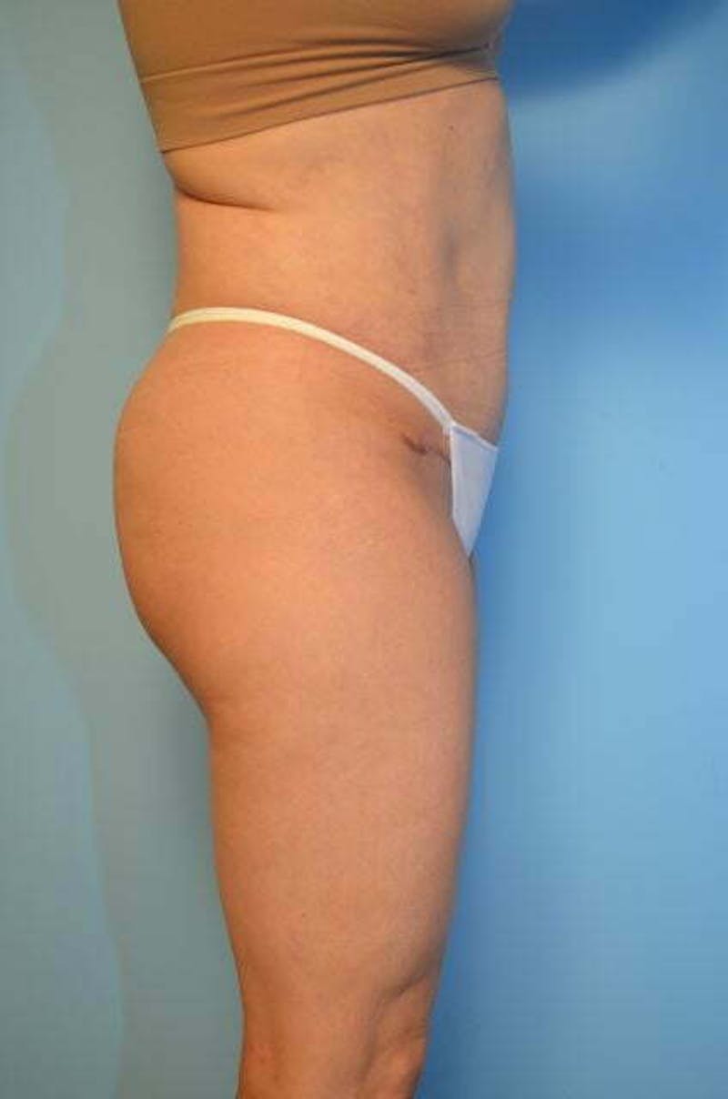 Umbilical Float Tummy Tuck Before & After Gallery - Patient 179410 - Image 6