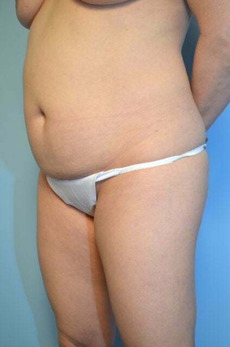 Umbilical Float Tummy Tuck Before & After Gallery - Patient 179410 - Image 7
