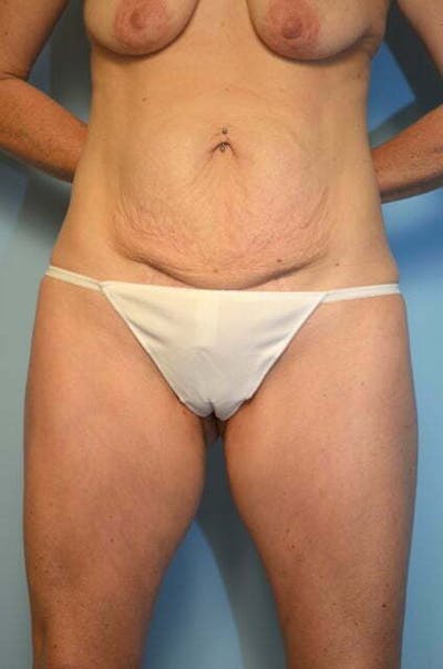 Umbilical Float Tummy Tuck Before & After Gallery - Patient 320835 - Image 1
