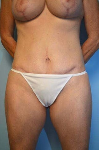 Umbilical Float Tummy Tuck Before & After Gallery - Patient 320835 - Image 2