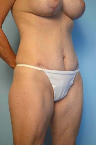 Umbilical Float Tummy Tuck Before & After Gallery - Patient 320835 - Image 4