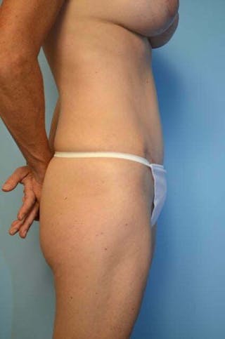 Umbilical Float Tummy Tuck Before & After Gallery - Patient 320835 - Image 6