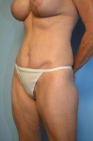 Umbilical Float Tummy Tuck Before & After Gallery - Patient 320835 - Image 8