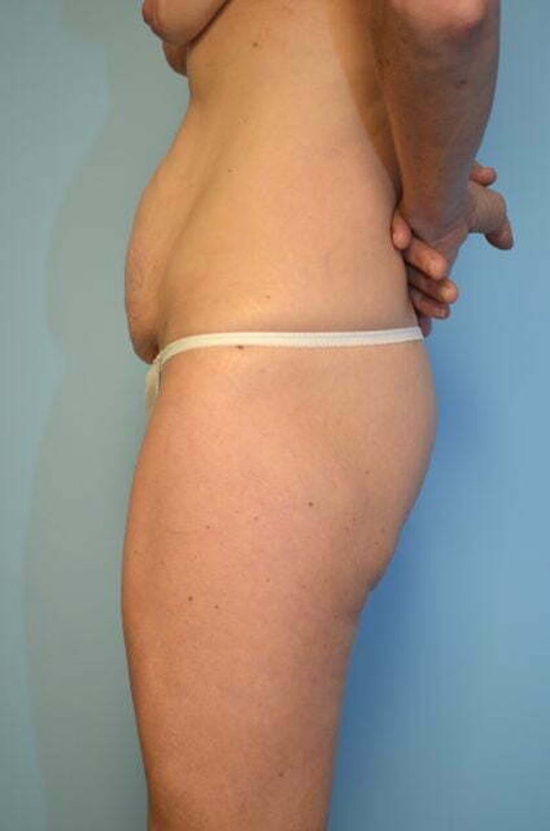 Umbilical Float Tummy Tuck Before & After Gallery - Patient 320835 - Image 9
