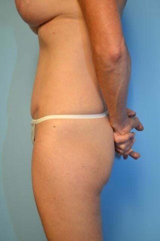 Umbilical Float Tummy Tuck Before & After Gallery - Patient 320835 - Image 10